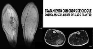 ondas de choque y rotura muscular